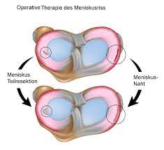 Daneben kann aber auch eine meniskusquetschung auftreten. Meniskusriss Symptome Ursachen Behandlung Www Gelenk Doktor De