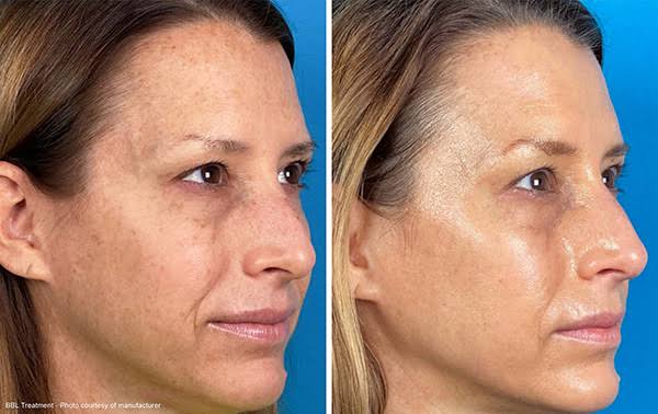Halo® & BBL® Laser Skin Resurfacing for Los Angeles, Torrance & Long Beach,  CA- South Bay Plastic Surgeons