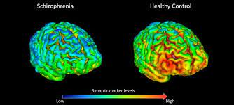 Articles on schizophrenia and your brain. New Study Finds Evidence For Reduced Brain Connections In Schizophrenia Eurekalert Science News