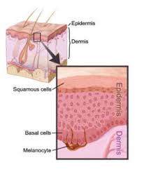 Because it is often caused by exposure to the sun, skin cancer is one of the most common cancers in the world. What Is Skin Cancer Roswell Park Comprehensive Cancer Center