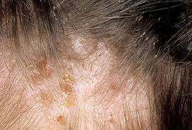 Image result for Lice