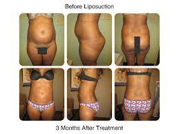 Kirk churukian, a plastic surgeon in san jose, california. Smart Liposuction Laser New Radiance Cosmetic Center Of St Lucie