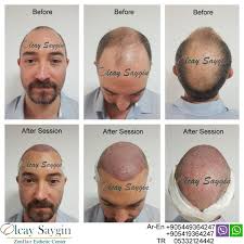 Best Hair Transplant Doctor In Turkey Hair Implants Hair Transplant Hair Transplant Uk