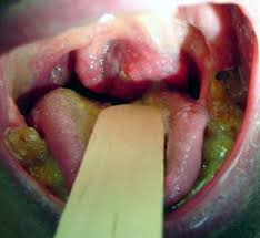 If you have any symptoms that worry you, be sure to see your doctor right away. Throat Cancer Squamous Cell Carcinoma Of The Tonsil Healthengine Blog