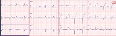 Dr Smith S Ecg Blog Ten 10 Examples Of Hyperacute T Waves In Lead V2 A Few In V3 Due To Acute Lad Occlusion