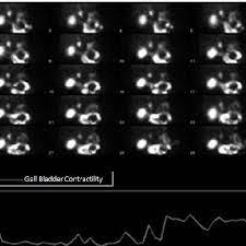 Hepatobiliary Iminodiacetic Acid Hida Scan Showing A Low Ejection Download Scientific Diagram