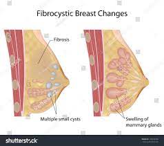 Fibrocystic breast causes and risk factors about half of women in their 20s to 50s will have fibrocystic breast changes. Fibrocystic Breast Changes How To Manage Them Iamdrssekandi
