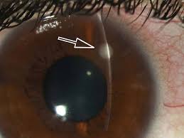 Image result for Keratitis