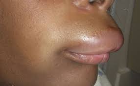Image result for Angioedema