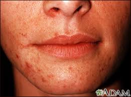 Image result for red rash face