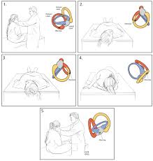 Image result for Canalith Repositioning Procedure
