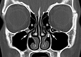 Pin On Sinus Resources