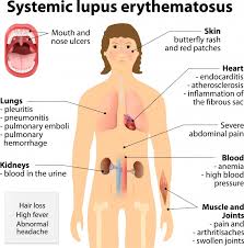 Autoimmune Disease A Breakdown Of Self Tolerance Massage Magazine