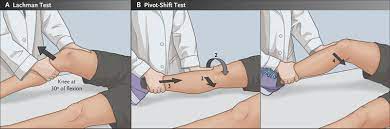 Basically acl is the integrated feature of ios software that is used to filter the network traffic passing through the ios devices. Anterior Cruciate Ligament Tear Nejm