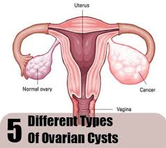Pin On Pcos Thyroid Hormones