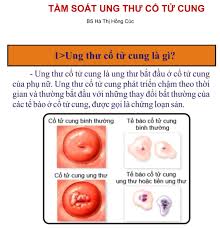 Ung thư tử cung mặc dù không có triệu chứng rõ ràng nhưng vẫn có những tín hiệu nhất định báo qua kinh nguyệt. Táº§m Soat Ung ThÆ° Cá»• Tá»­ Cung Bá»‡nh Viá»‡n Hung VÆ°Æ¡ng