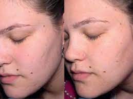 This means that your body does not naturally shed cells as efficiently from the surface of the skin, adds zeichner. Micro Needling For Acne Scars How To Do It Right