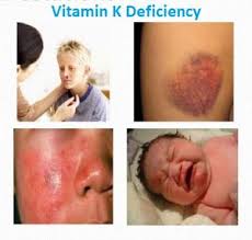 Pin By هنيف محمد On Vitamin K Deficiency In 2020 Vitamin K Vitamins Vitamin K Deficiency