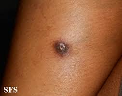 Image result for Dermatofibrosarcoma Protuberans
