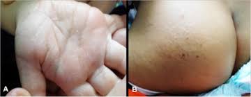 Image result for Papular Acrodermatitis