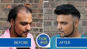hair4all Non-Surgical Hair Replacement System Chat with Parvez and Phil  Osmond