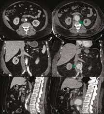 La aorta es un vaso sanguíneo grande que sale del corazón y va al abdomen. Aneurismas De Aorta Abdominal Rotos E Com Risco Iminente De Ruptura