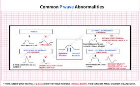 Image result for P Wave