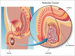 It has an average five year survival rate as high as 99%, depending on how early the cancer is detected. Symptoms And Signs For Testicular Cancer Do Not Ignore