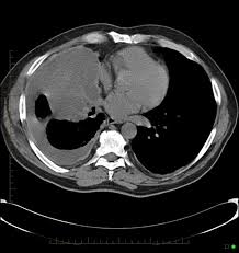 This condition is usually associated with occupational exposure to asbestos. Mesothelioma Radiology Case Radiopaedia Org