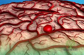 This provides an image of the blood vessels in the brain to detect a problem with vessels and blood flow. Aneurisma Cerebral Etiologia Clinica Regenerati Neurologia