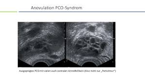 Transvaginaler ultraschall ist eines der wichtigsten instrumente eines arztes zur diagnose des polyzystischen ovarialsyndroms (pcos). Rationelle Diagnostik Der Anovulation