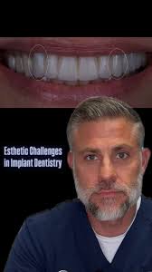 Titanium implants can sometimes create esthetic challenges when they show  through thin gum tissue — affecting the natural look of a smile. In this  video, we address discoloration and ways to help ...