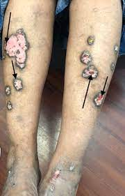 The cause of the inflammation that leads to lichen planus is unknown. Cureus Hypertrophic Lichen Planus Mimicking Verrucous Lupus Erythematosus