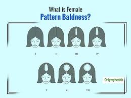 As you go through your hair loss journey, don't compare yourself to women you see on tv or. Female Pattern Hair Loss Symptoms Stages And Treatment
