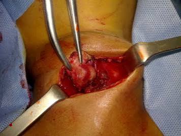 Kyste hydatique de la thyroïde chez l'enfant - ScienceDirect