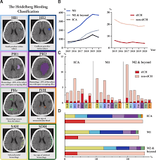 Image result for Hemorrhage Classification