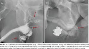 Image result for Retrograde Urethrogram