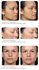 Solta's portfolio includes the thermage rf systems, fraxel laser, clear + brilliant laser and vaser ultrasonic systems. Clear Brilliant