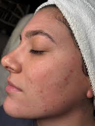 Emily Hansen Sessions (@emilysessions_skincare) • Instagram photos and  videos