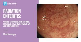 Image result for Radiation Colitis