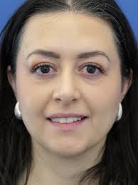 Cases in Blepharoplasty Upper