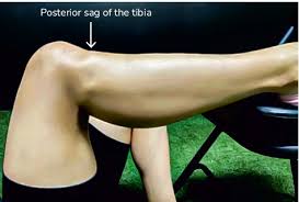 Image result for PCL Sulcus Test