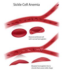 Sickle cell disease (scd) is a common inherited blood disorder in the united states, affecting an estimated 70,000 to 100,000 americans. Sickle Cell Disease Medlineplus Genetics