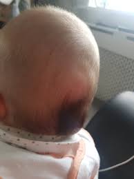Hard Lump On Back On My Boys Head Babycentre