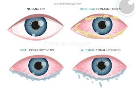 Image result for Viral Conjunctivitis