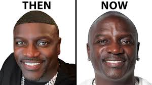Our Skincare & Haircare: https://feelconfident.com/ use code CELEB10 for  10% off!, For Surgical Consultations: (347) 434-8397, What happened to  Akon's hair transplant? Did Akon reverse his hair ...