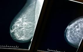 Generally, whiter mammogram images indicate denser breasts. Women Should Be Told About Their Breast Density When They Have A Mammogram