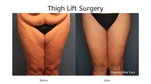 The adductors or inner thigh muscles run from the groin to the knees (1). 3 Ways To Slimmer Legs Dr Al Cohn
