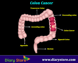 What is metastatic colon cancer? Colon Cancer Metastasis Colon Cancer Symptoms