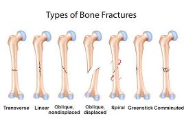 Healthy Bones And Beyond Google Search Bone Fracture Types Of Bones Types Of Fractures